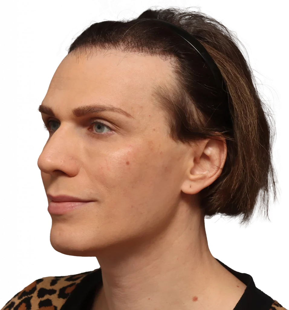 Angled left profile photo of Lucia before surgery.