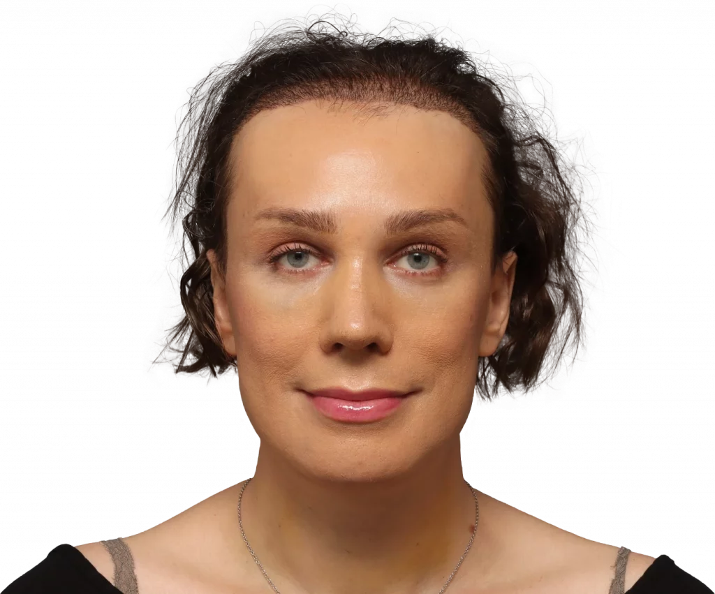 frontal profile photo of Lucia after surgery.