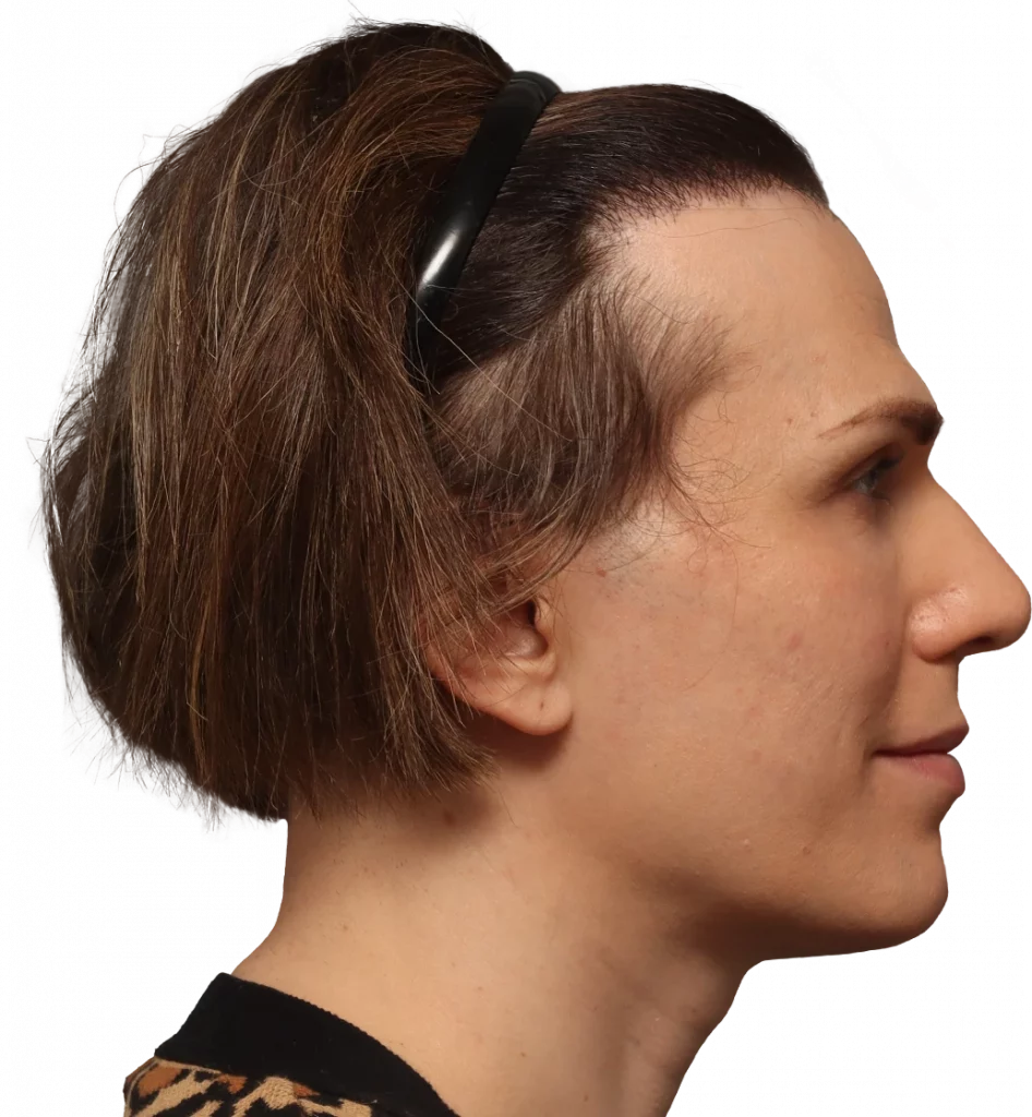 Side right profile photo of Lucia before surgery.