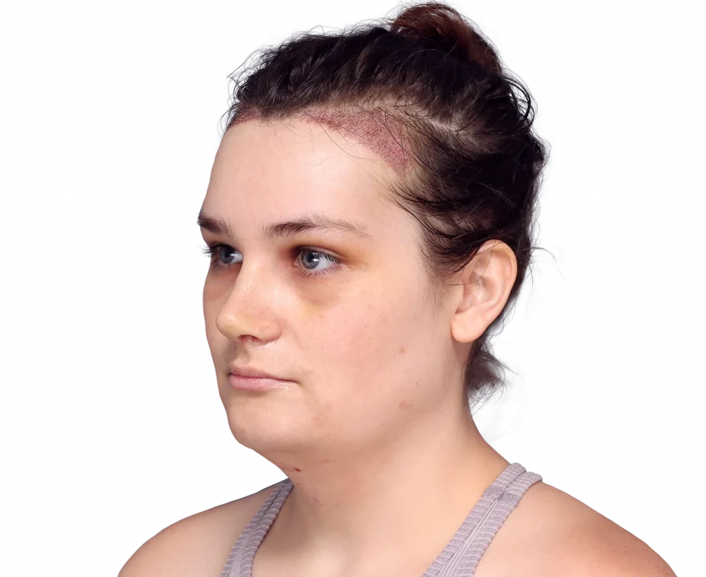 Angled left profile photo of Alex after surgery.