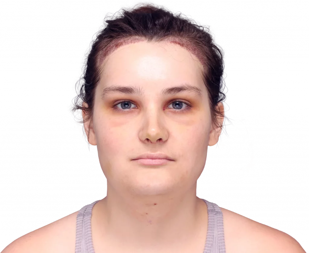 Frontal profile photo of Alex after surgery.