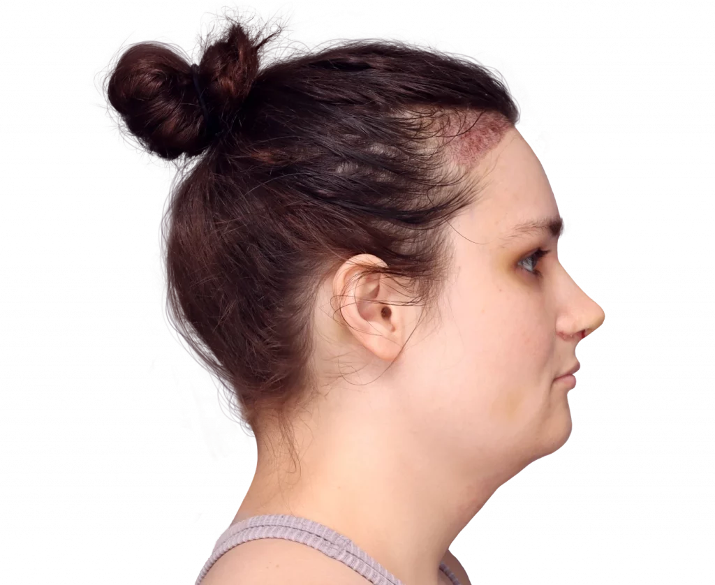 Side right profile photo of Alex after surgery.