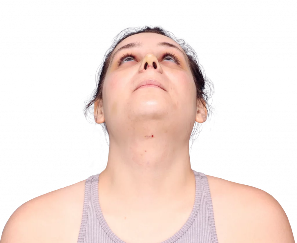 Frontal up profile photo of Alex after surgery.