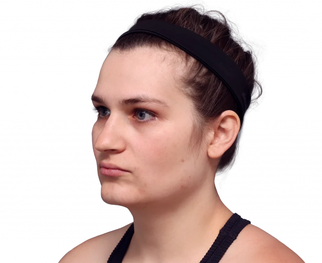Angled left profile photo of Alex before surgery.