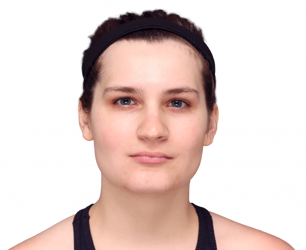 Frontal profile photo of Alex before surgery.