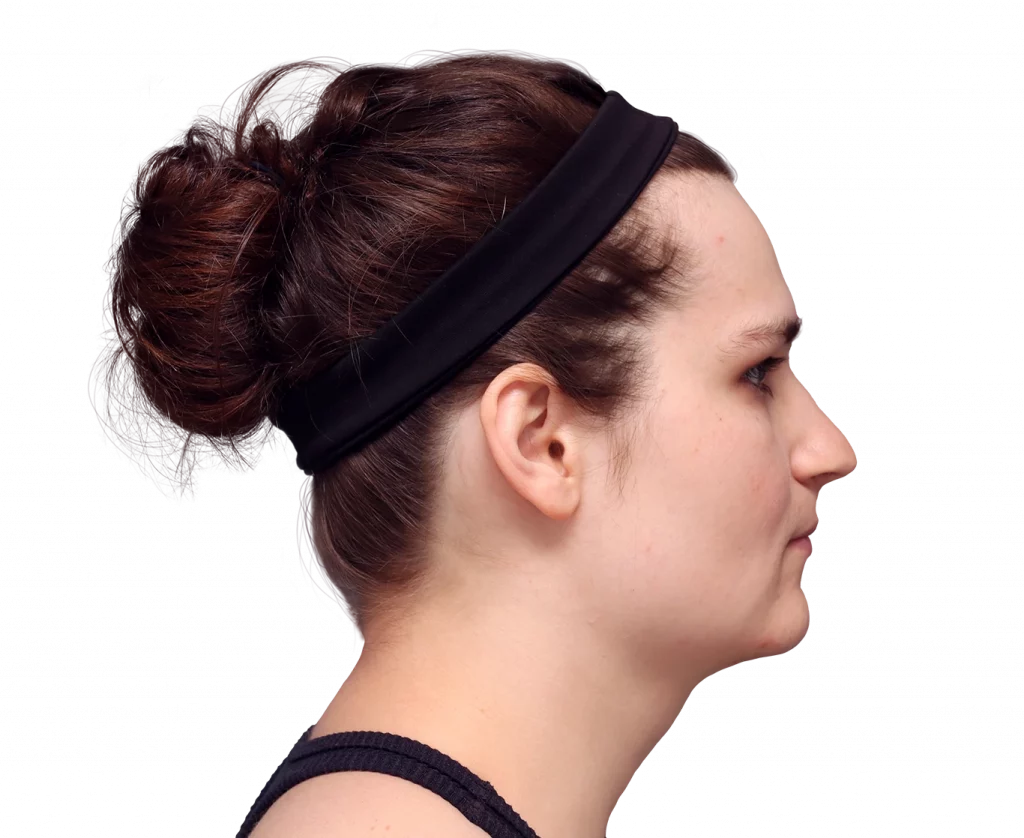 Side right profile photo of Alex before surgery.