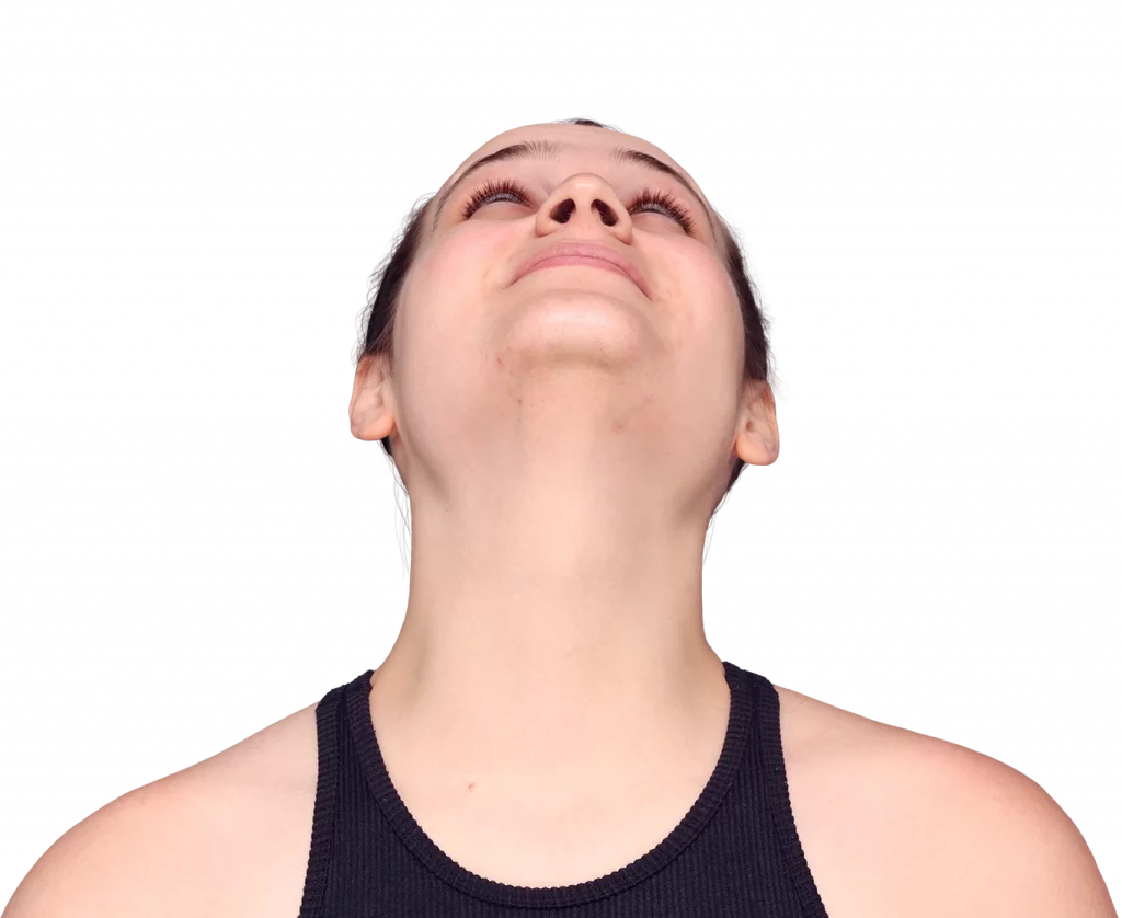 Frontal up profile photo of Alex before surgery.