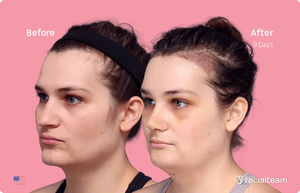 Angled left image of FFS patient Alex showing the results before-after with Facialteam consisting of forehead with hair tranplant, rhinoplasty, chin and tracheal shave feminization surgery.