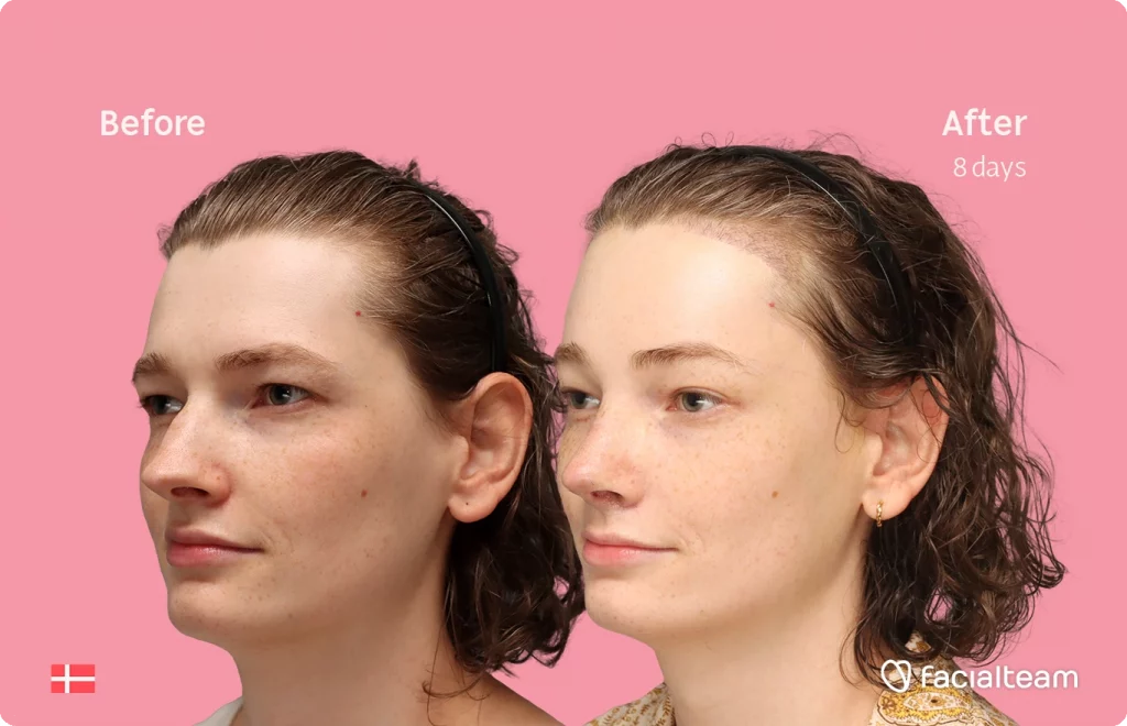 Angled left image of FFS patient Aline showing the results before-after with Facialteam consisting of forehead with hair tranplant and rhinoplasty feminization surgery.