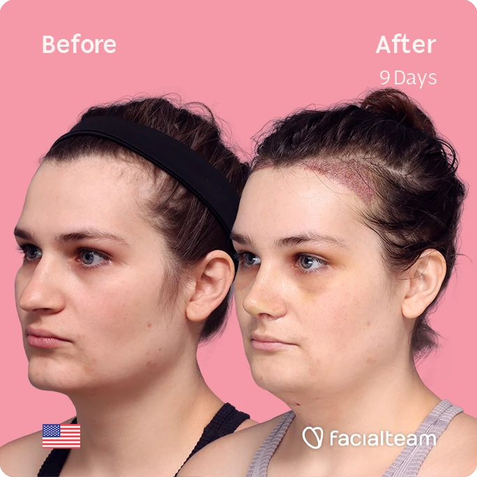 Angled left square image of FFS patient Alex showing the results before-after with Facialteam consisting of forehead with hair tranplant, rhinoplasty, chin and tracheal shave feminization surgery.