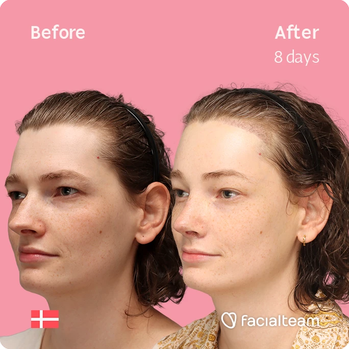 Angled left square image of FFS patient Aline showing the results before-after with Facialteam consisting of forehead with hair tranplant and rhinoplasty feminization surgery.