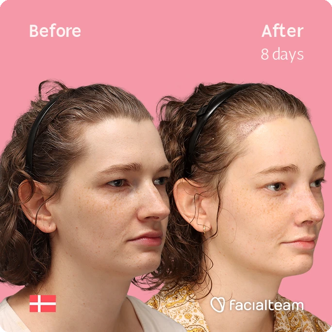 Angled right square image of FFS patient Aline showing the results before-after with Facialteam consisting of forehead with hair tranplant and rhinoplasty feminization surgery.