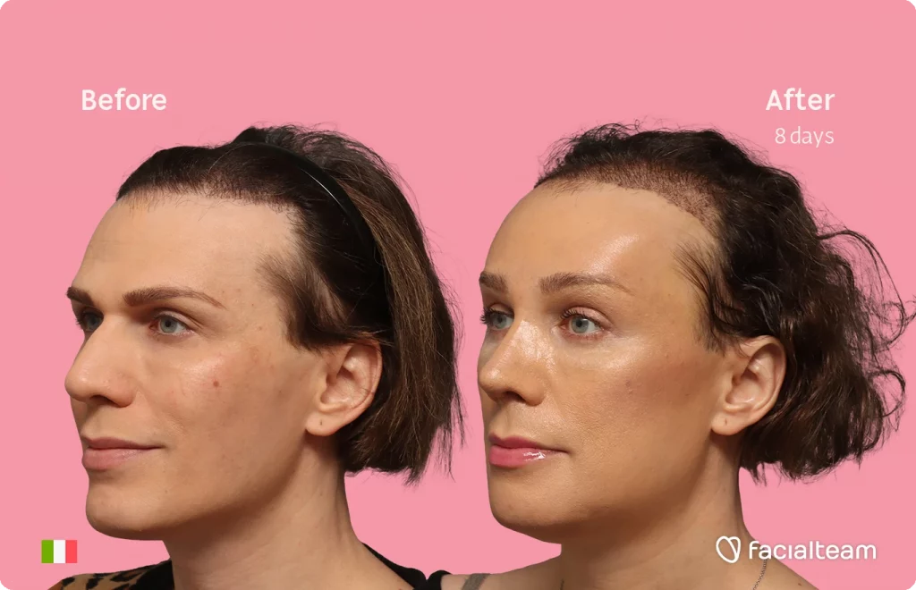 Angled left image of FFS patient Lucia showing the results before-after with Facialteam consisting of forehead with hair tranplant, rhinoplasty, jaw and chin feminization surgery.