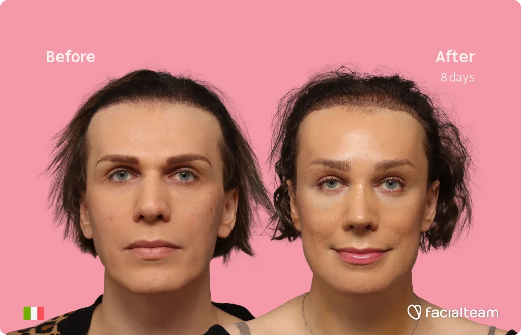 Frontal image of FFS patient Lucia showing the results before-after with Facialteam consisting of forehead with hair tranplant, rhinoplasty, jaw and chin feminization surgery.