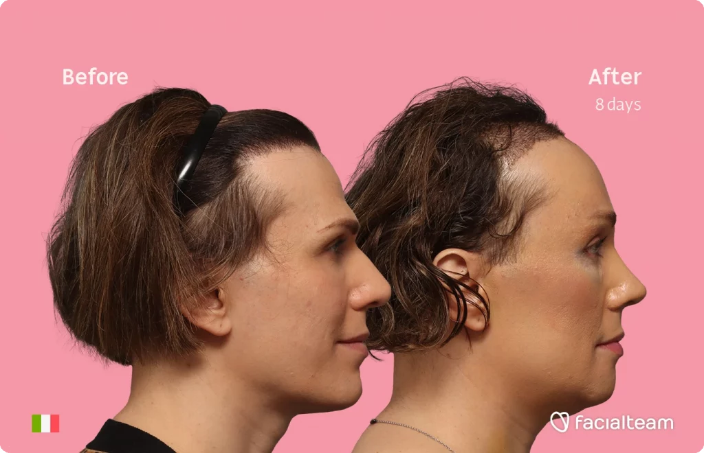 Side right image of FFS patient Lucia showing the results before-after with Facialteam consisting of forehead with hair tranplant, rhinoplasty, jaw and chin feminization surgery.