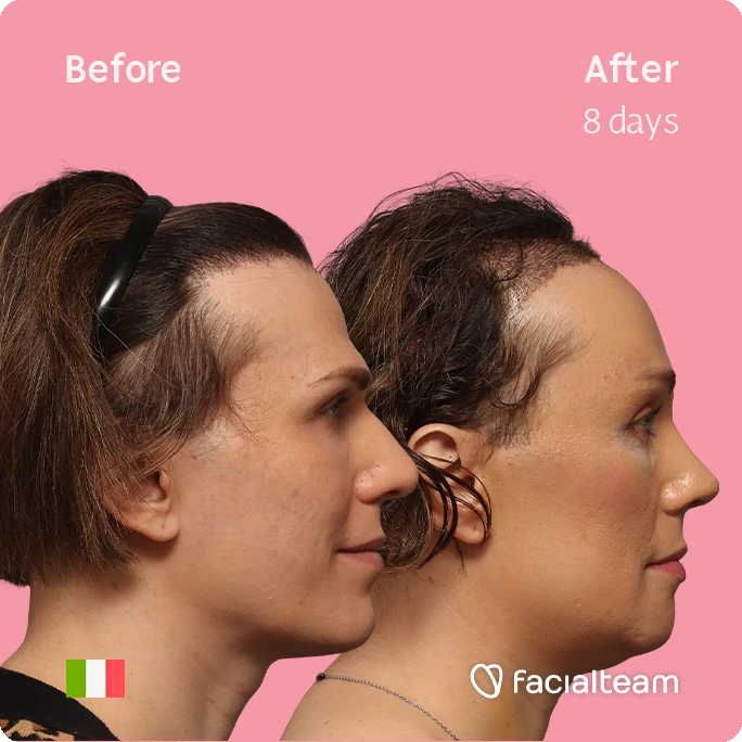 Side right square image of FFS patient Lucia showing the results before-after with Facialteam consisting of forehead with hair tranplant, rhinoplasty, jaw and chin feminization surgery.