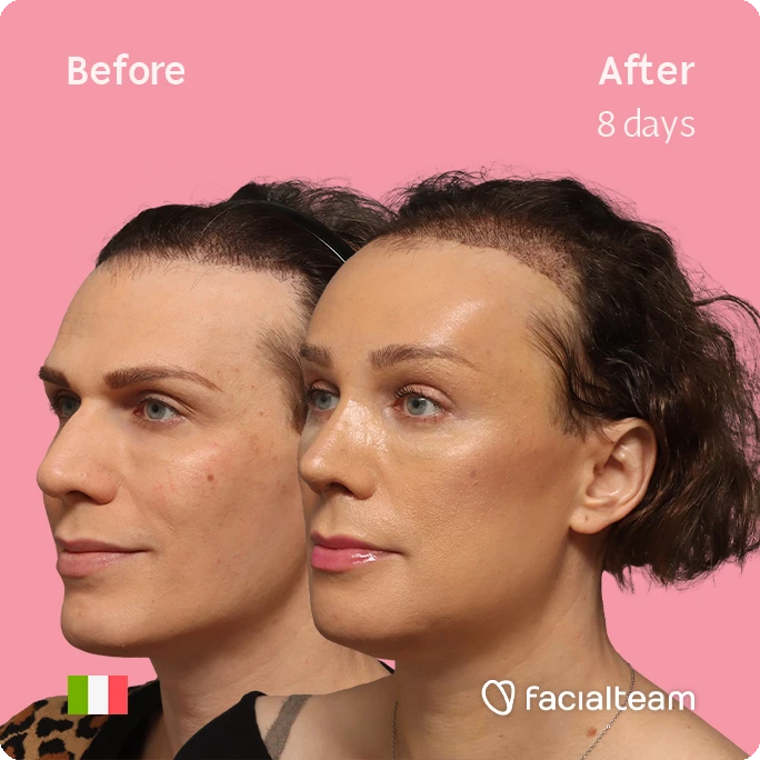 Angled left square image of FFS patient Lucia showing the results before-after with Facialteam consisting of forehead with hair tranplant, rhinoplasty, jaw and chin feminization surgery.