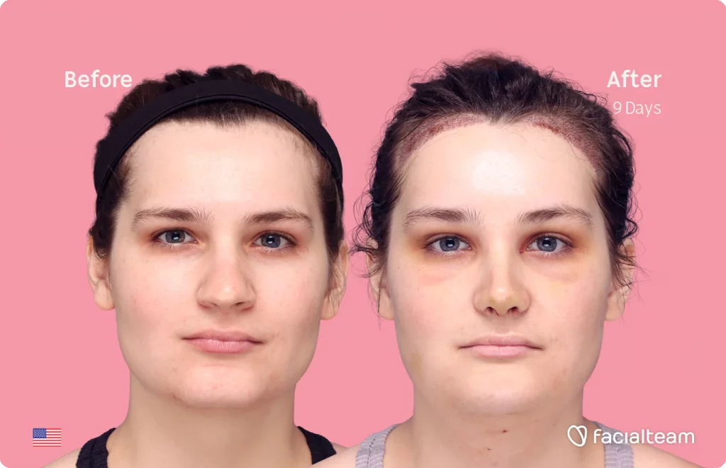 Frontal image of FFS patient Alex showing the results before-after with Facialteam consisting of forehead with hair tranplant, rhinoplasty, chin and tracheal shave feminization surgery.