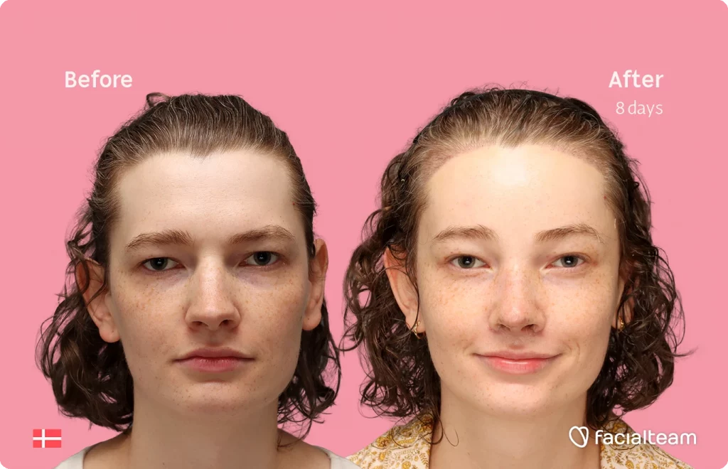 Frontal image of FFS patient Aline showing the results before-after with Facialteam consisting of forehead with hair tranplant and rhinoplasty feminization surgery.
