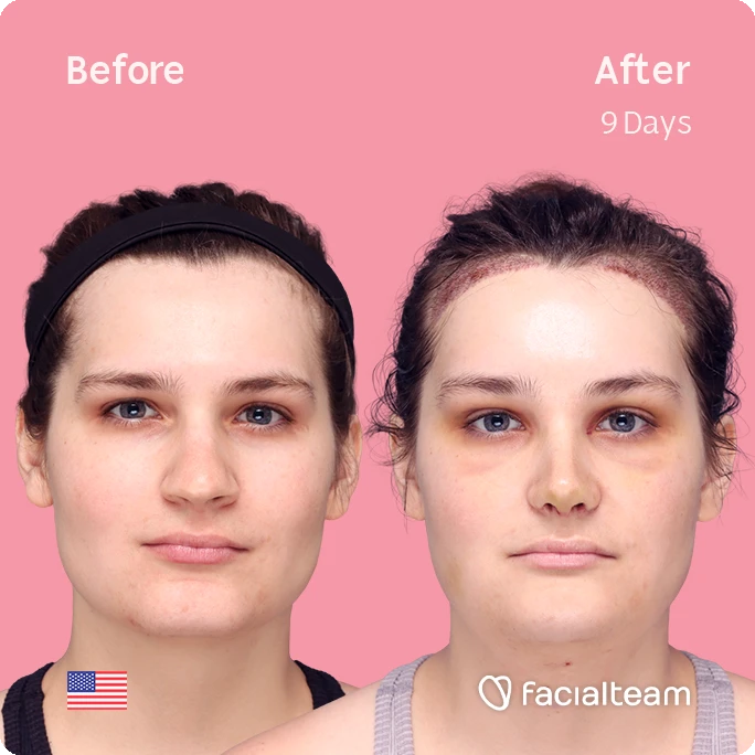 Frontal square image of FFS patient Alex showing the results before-after with Facialteam consisting of forehead with hair tranplant, rhinoplasty, chin and tracheal shave feminization surgery.