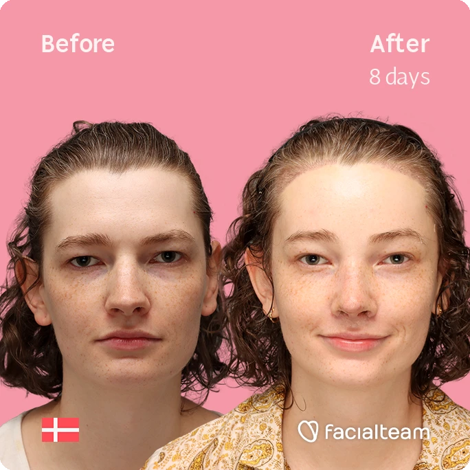 Frontal square image of FFS patient Aline showing the results before-after with Facialteam consisting of forehead with hair tranplant and rhinoplasty feminization surgery.