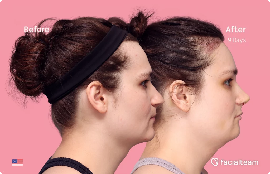 Side right image of FFS patient Alex showing the results before-after with Facialteam consisting of forehead with hair tranplant, rhinoplasty, chin and tracheal shave feminization surgery.