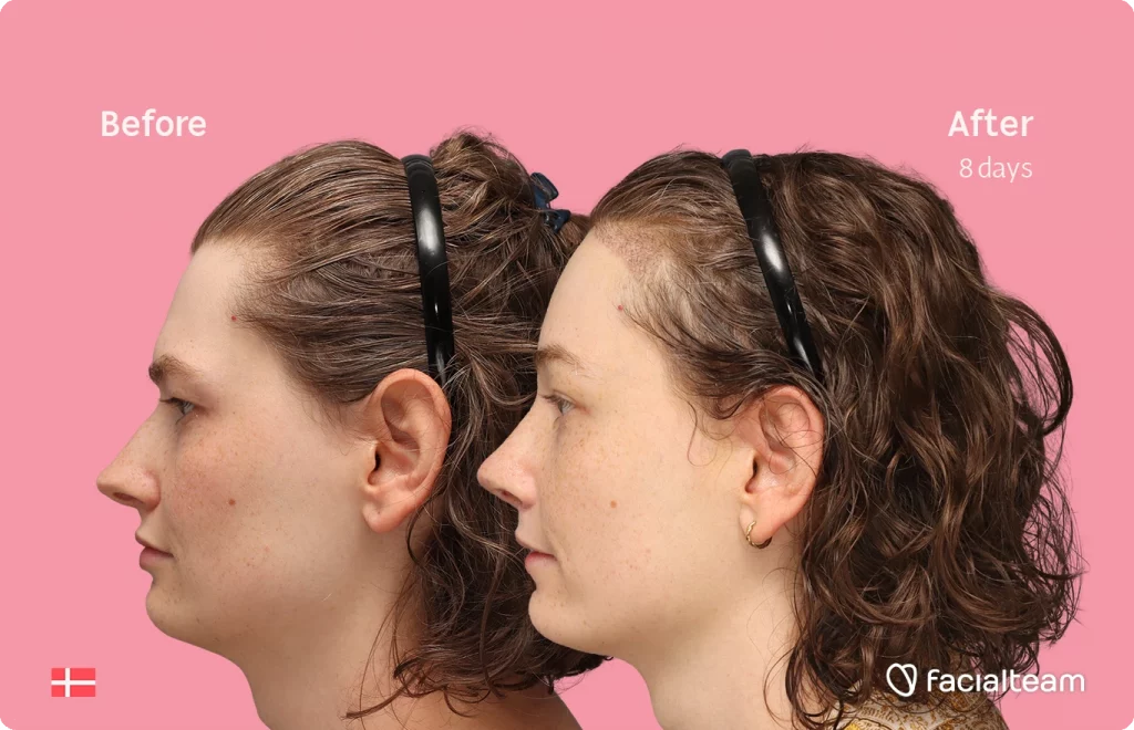 Side left image of FFS patient Aline showing the results before-after with Facialteam consisting of forehead with hair tranplant and rhinoplasty feminization surgery.