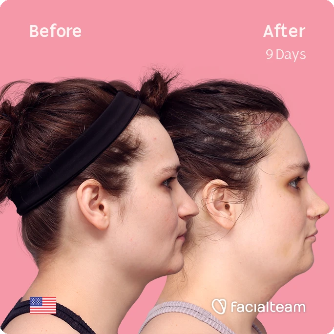 Side right square image of FFS patient Alex showing the results before-after with Facialteam consisting of forehead with hair tranplant, rhinoplasty, chin and tracheal shave feminization surgery.