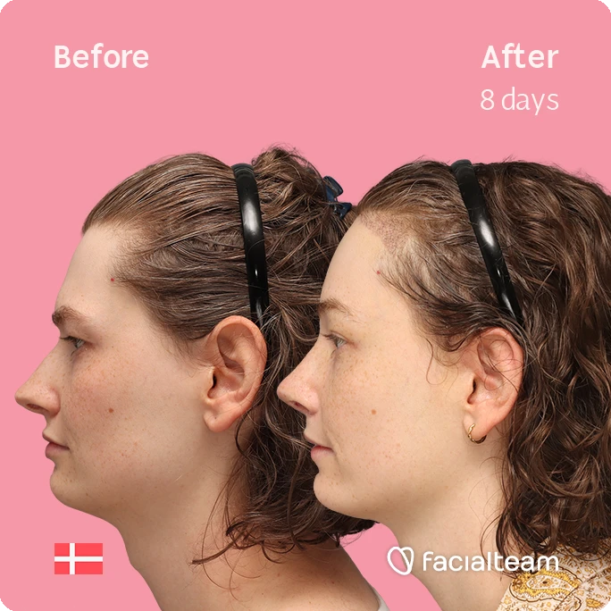 Side left square image of FFS patient Aline showing the results before-after with Facialteam consisting of forehead with hair tranplant and rhinoplasty feminization surgery.