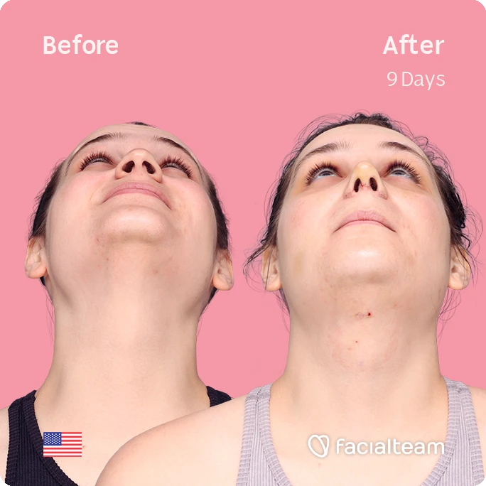 Frontal up square image of FFS patient Alex showing the results before-after with Facialteam consisting of forehead with hair tranplant, rhinoplasty, chin and tracheal shave feminization surgery.