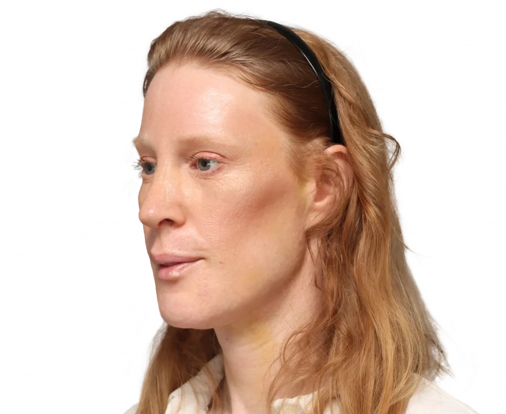Angled left profile photo of Laura after surgery.