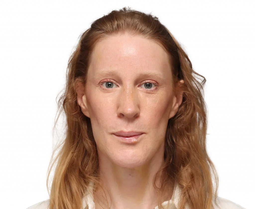 Frontal profile photo of Laura after surgery.