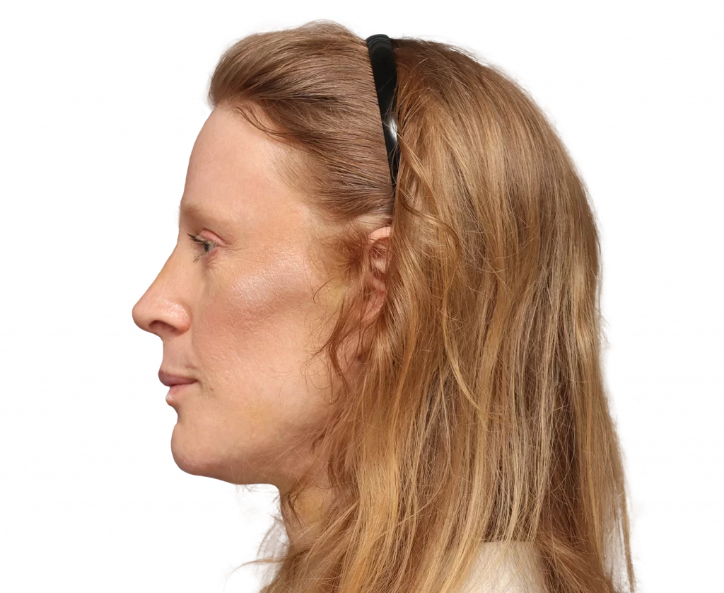 Side left profile photo of Laura after surgery.