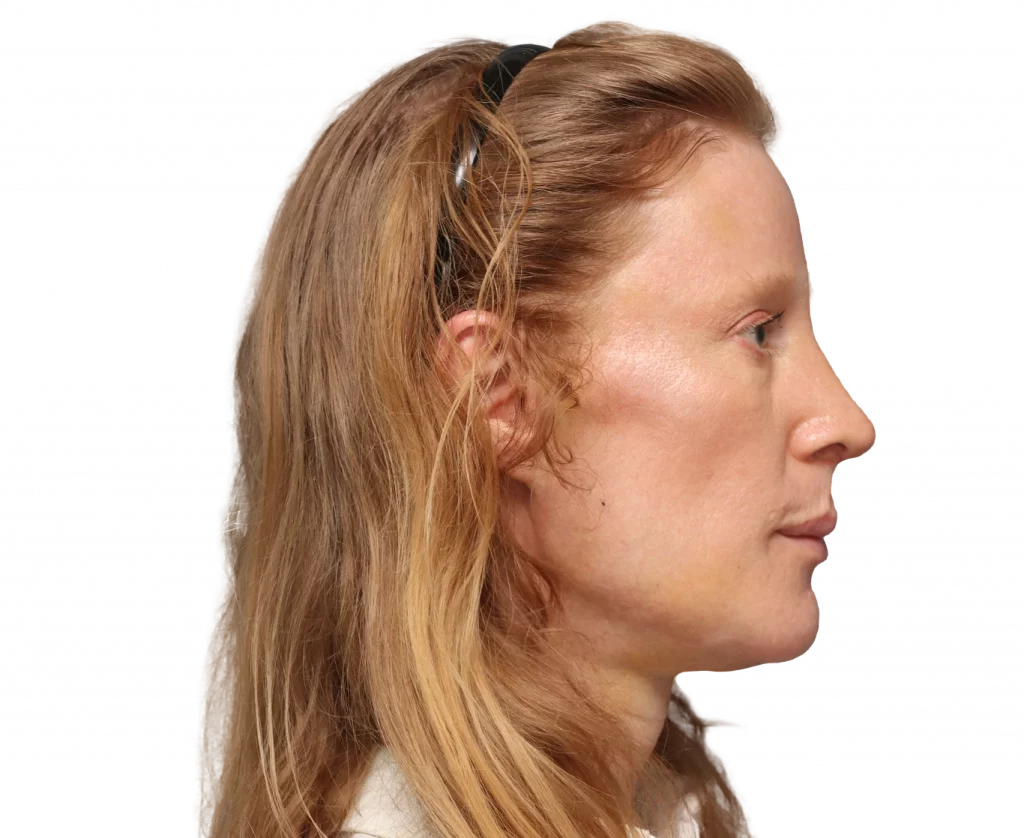 Side right profile photo of Laura after surgery.