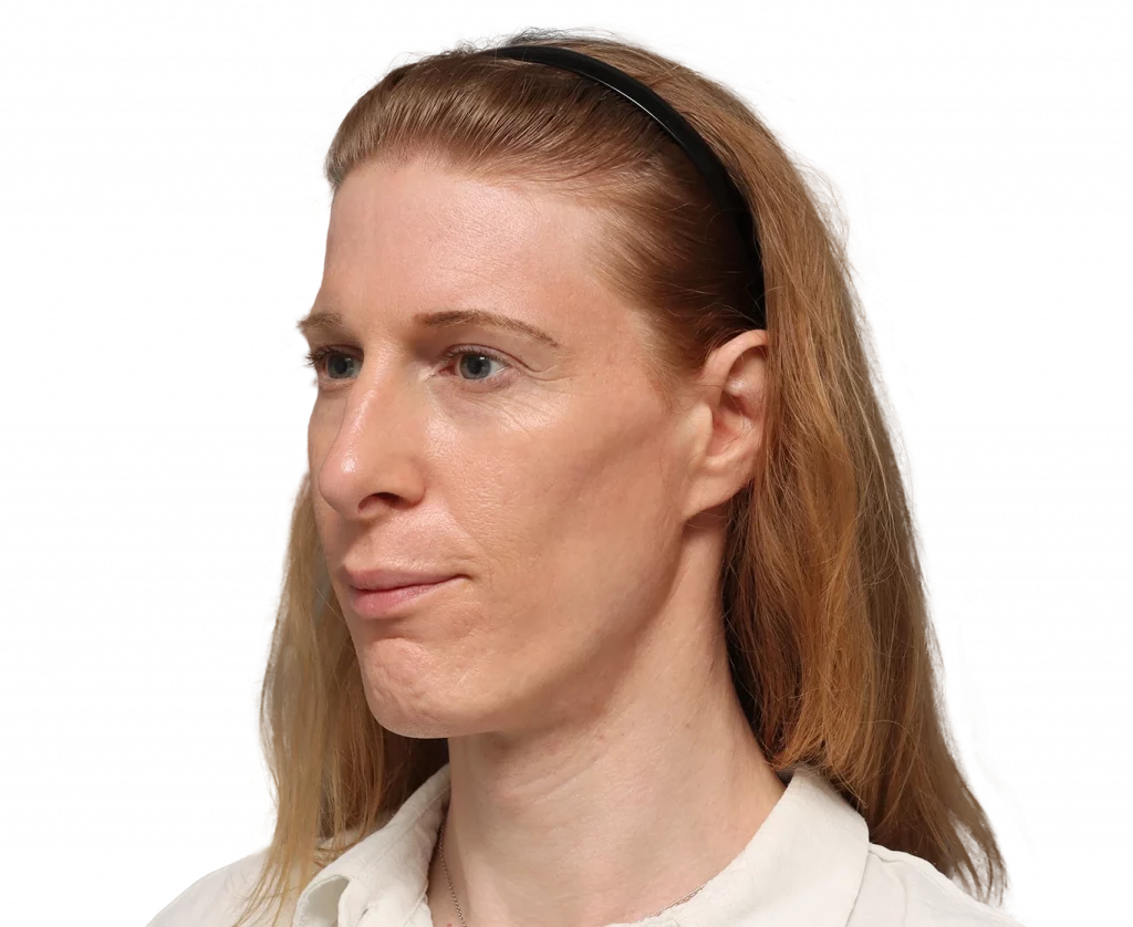 Angled left profile photo of Laura before surgery.