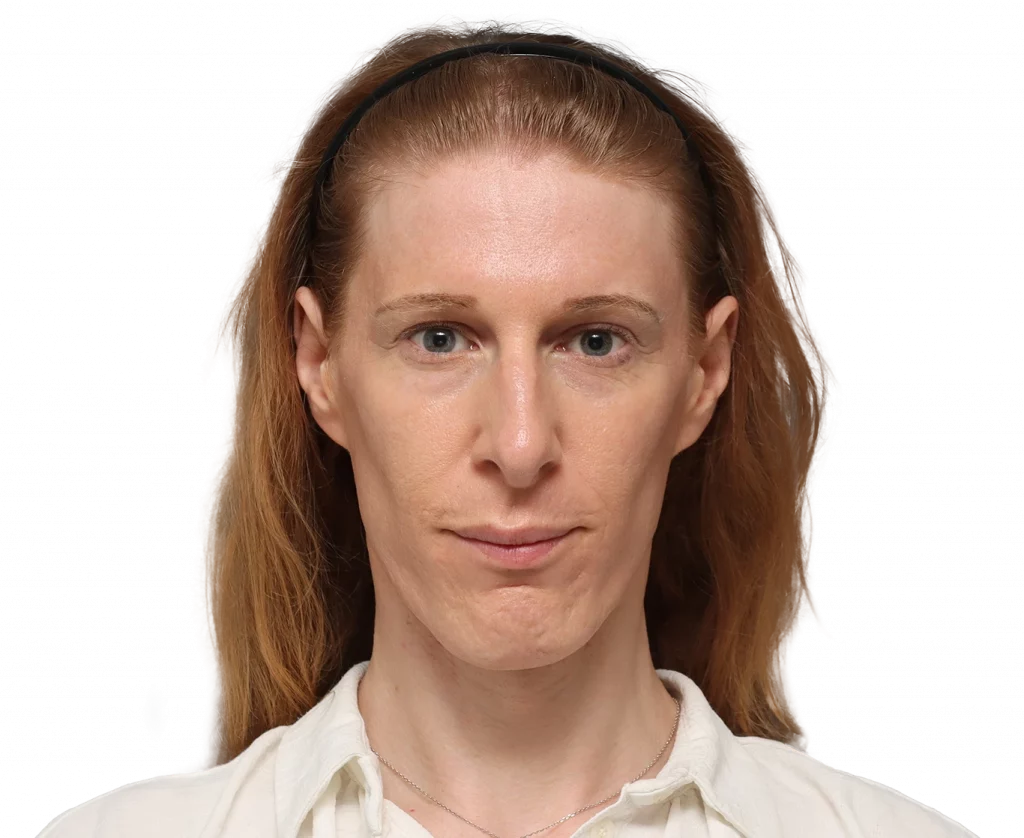 Frontal profile photo of Laura before surgery.