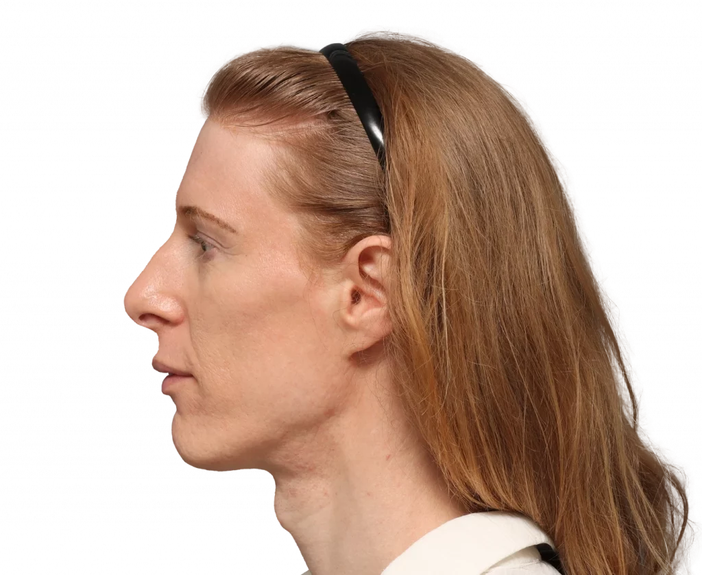 Side left profile photo of Laura before surgery.