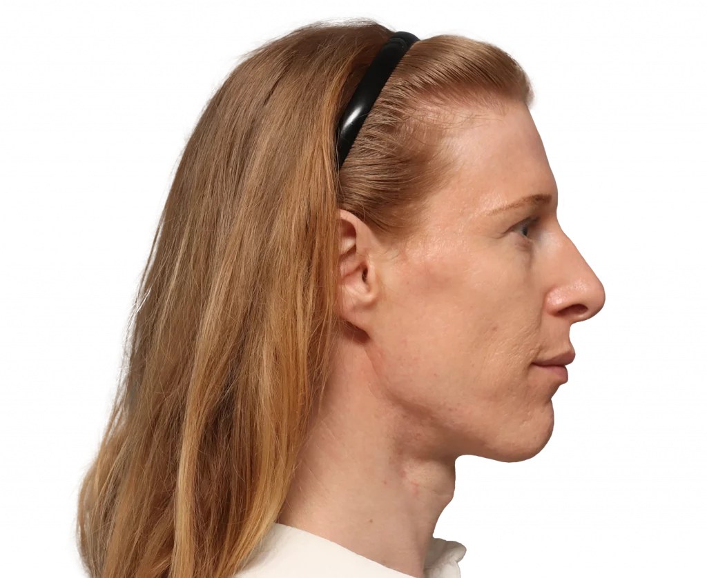 Side right profile photo of Laura before surgery.