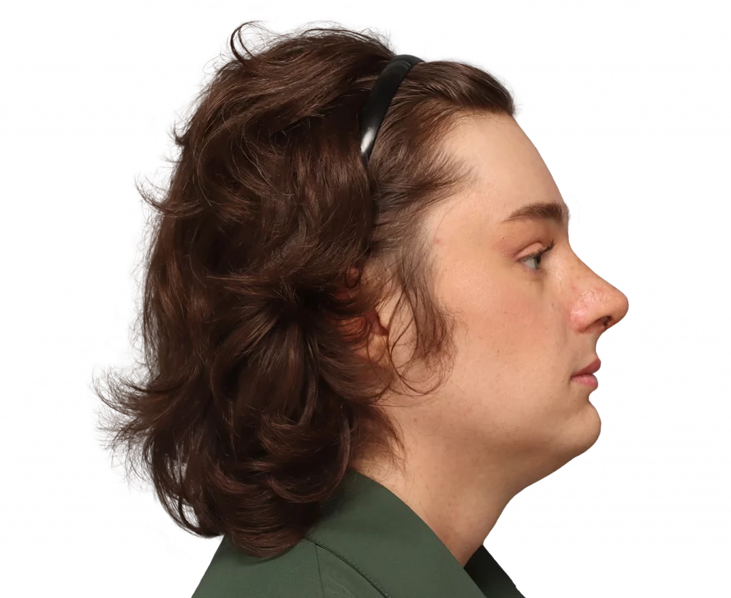 Side right profile photo of Lilly after surgery.