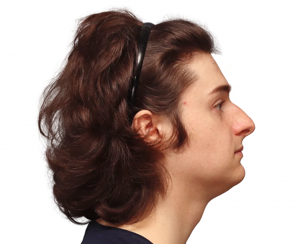 Side right profile photo of Lilly before surgery.