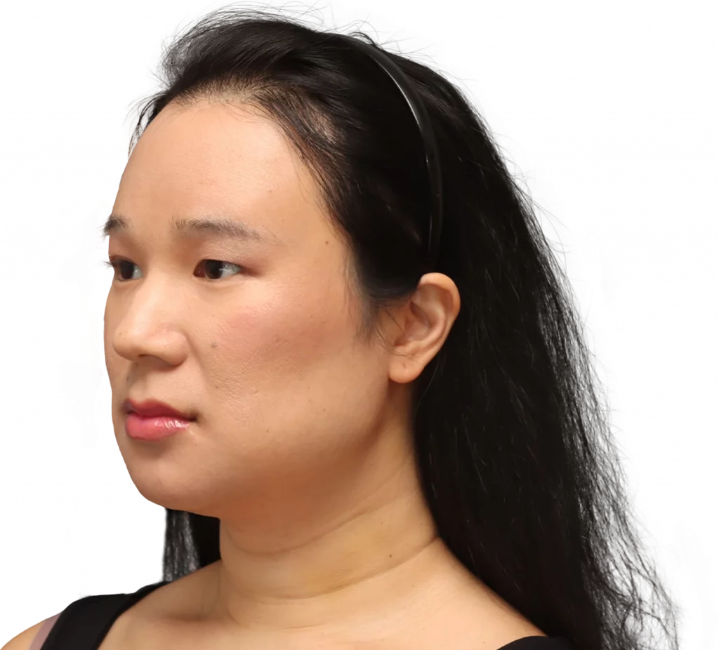 Angled left profile photo of Shyan after surgery.