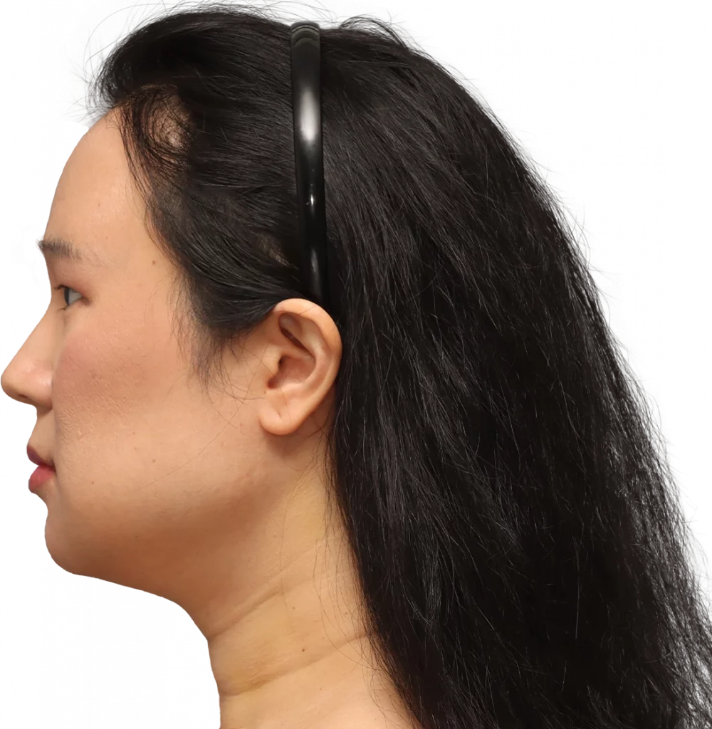 Side left profile photo of Shyan after surgery.