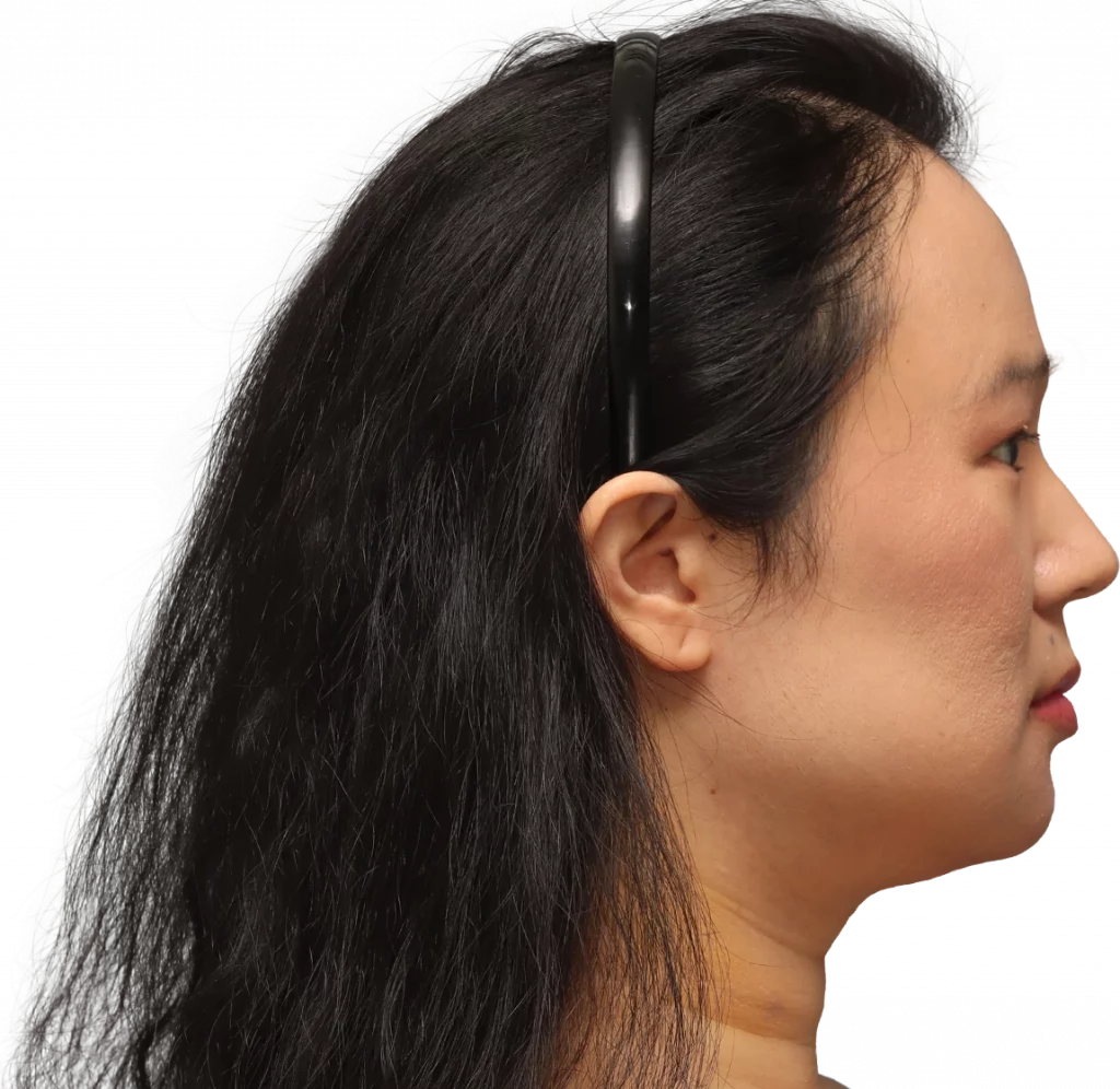 Angled right profile photo of Shyan after surgery.