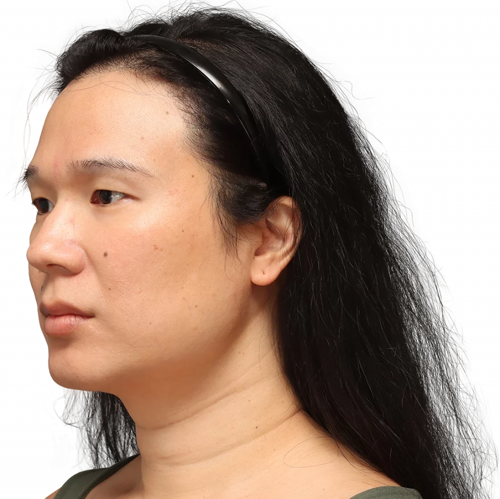 Angled left profile photo of Shyan before surgery.