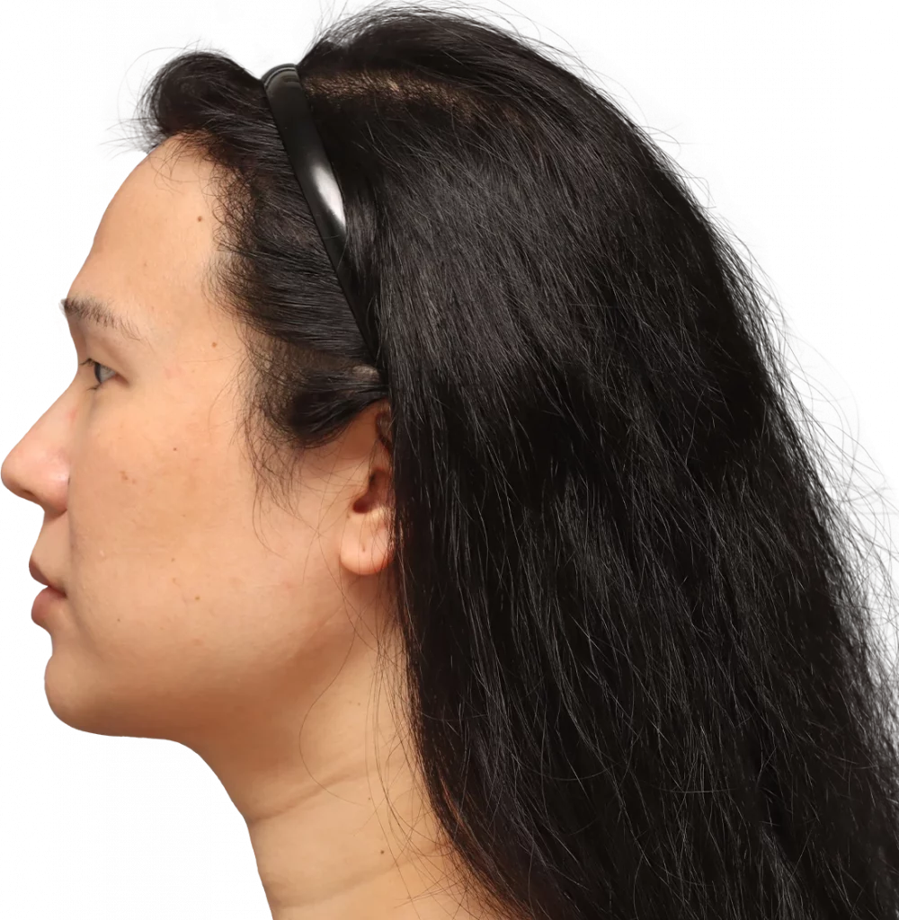 Side left profile photo of Shyan before surgery.