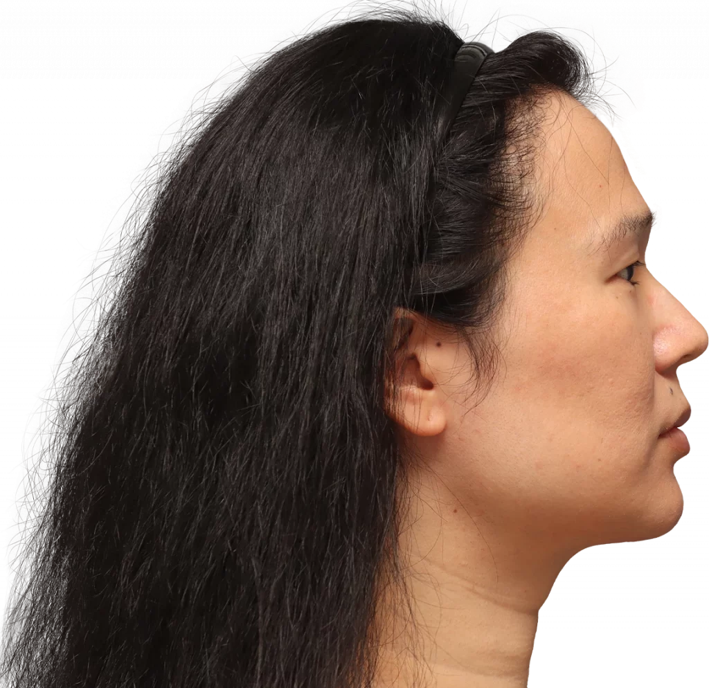 Side right profile photo of Shyan before surgery.