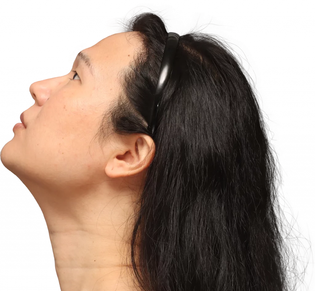 side left up profile photo of Shyan before surgery.