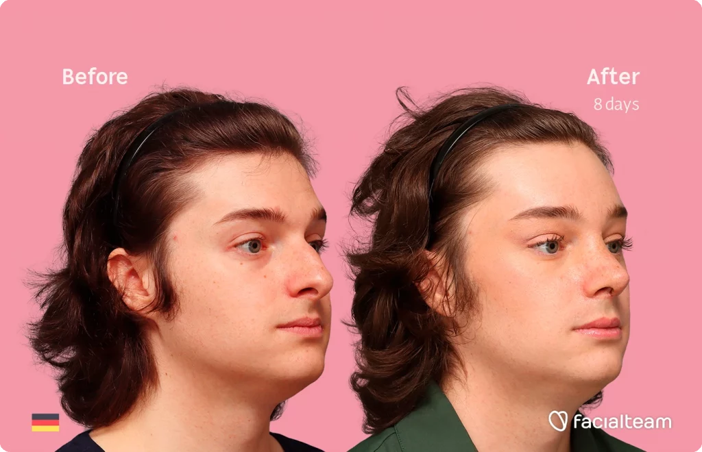 Angled right image of FFS patient Lilly T. showing the results before-after with Facialteam consisting of forehead and rhinoplasty feminization surgery.