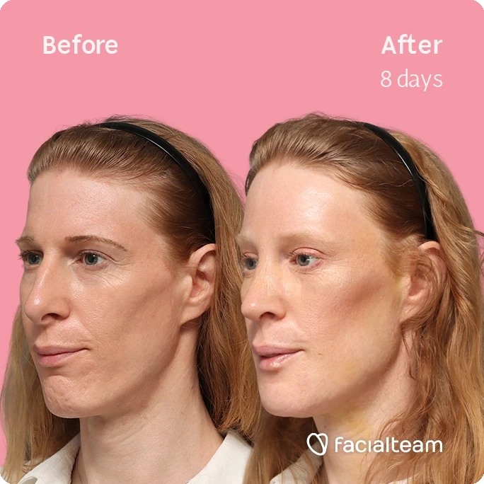 Angled square left image of FFS patient Laura M. showing the results before-after with Facialteam consisting of forehead, rhinoplasty, chin, tracheal shave feminization surgery and HIFU as secondary procedure.