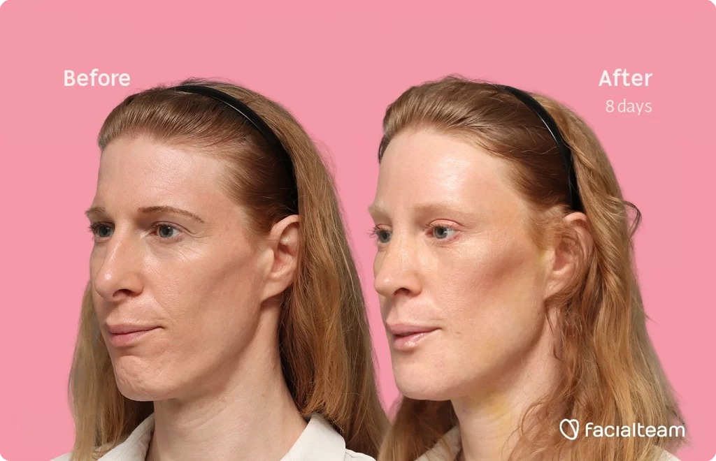 Angled left image of FFS patient Laura M. showing the results before-after with Facialteam consisting of forehead, rhinoplasty, chin, tracheal shave feminization surgery and HIFU as secondary procedure.